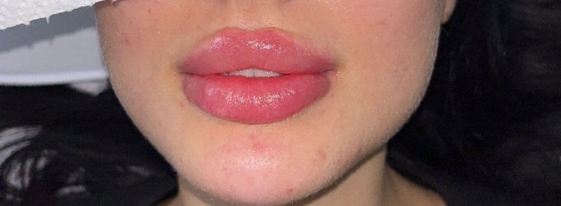 Hyaluron Unterspritzung: Natürliches Volumen für Lippen und Wangen