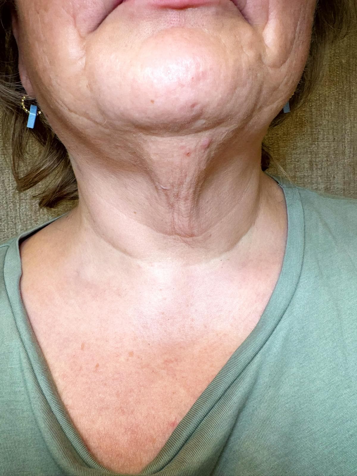 HIFU Ultraschall: Das natürliche Facelift ohne Operation
